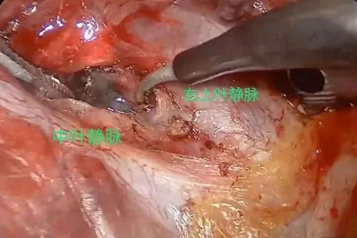 【胸腔镜篇】详述隧道法 【胸腔镜篇】详述隧道法
