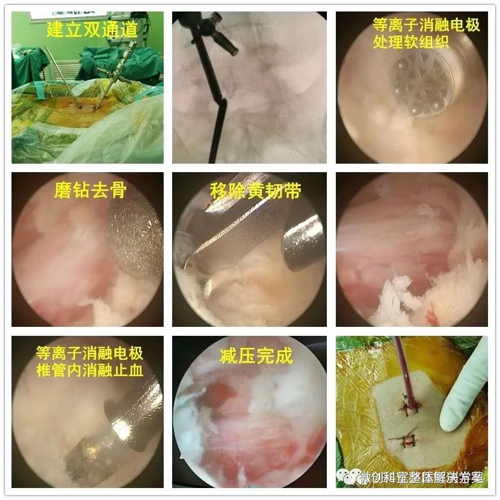 椎間孔鏡篇ube微創手術整體解決方案