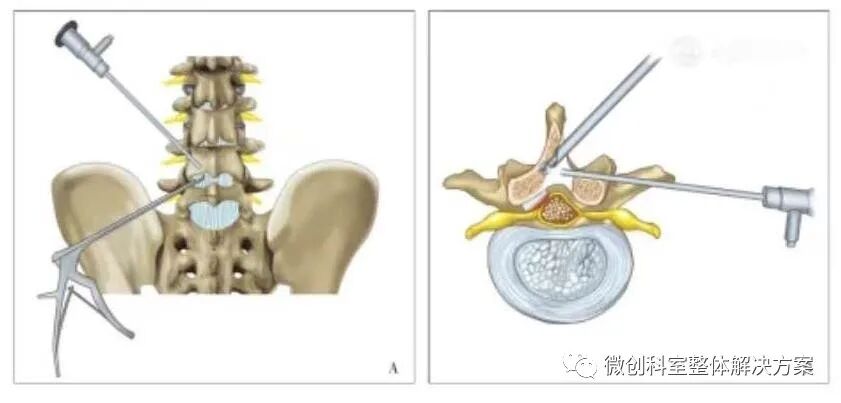 ube(unilateral biportal endoscopy)技术是指单边双通道内镜下的脊柱