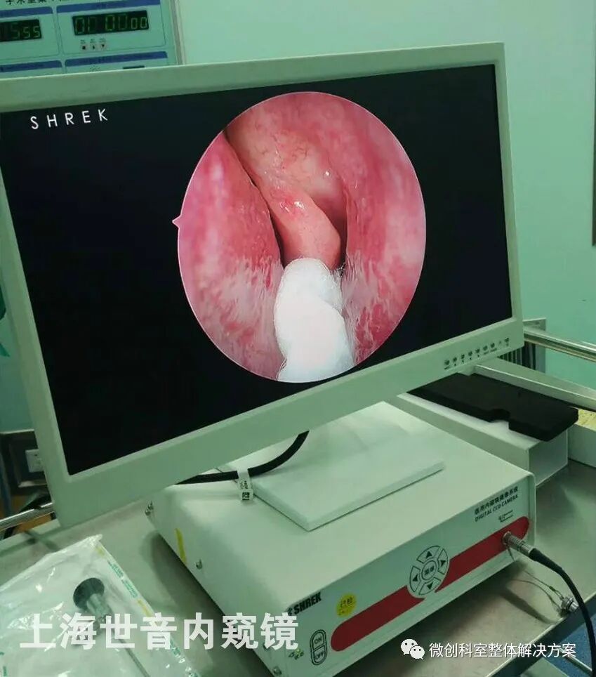 耳鼻喉镜篇鼻息肉