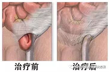 疝气补片怎么固定【腹腔镜篇】疝修补术——疝气的最佳手术方式_https://www.jmylbn.com_新闻资讯_第11张