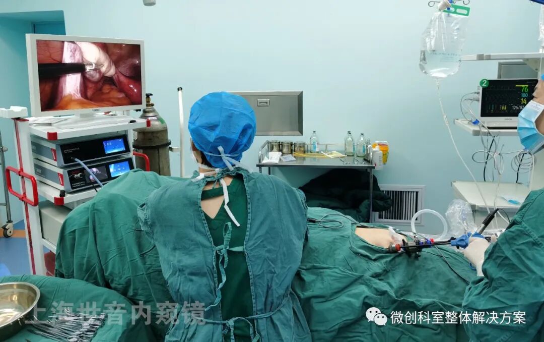 妇科电凝是什么【妇科腹腔镜篇】多囊卵巢打孔术-上海聚慕医疗器械有限公司