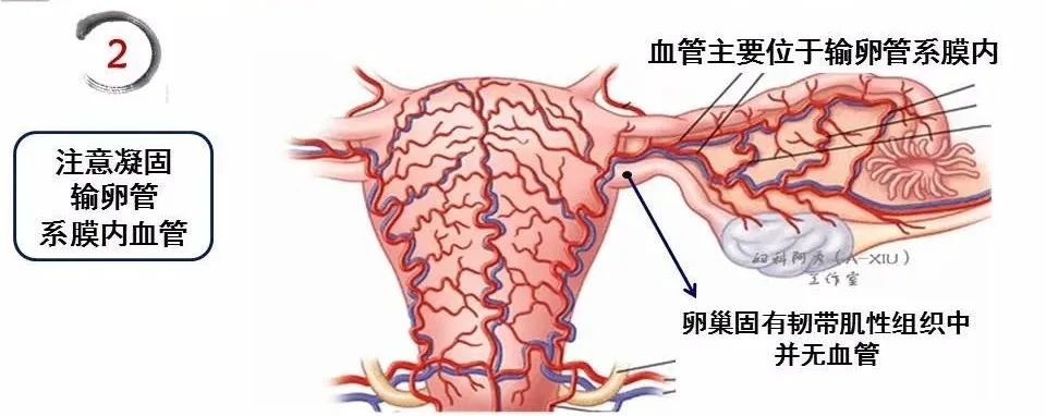 【腹腔镜篇】全子宫切除术手术技巧 【腹腔镜篇】全子宫切除术手术技巧