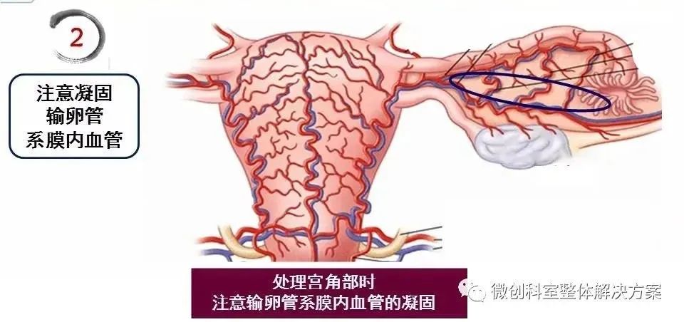 【腹腔镜篇】全子宫切除术手术技巧 【腹腔镜篇】全子宫切除术手术技巧