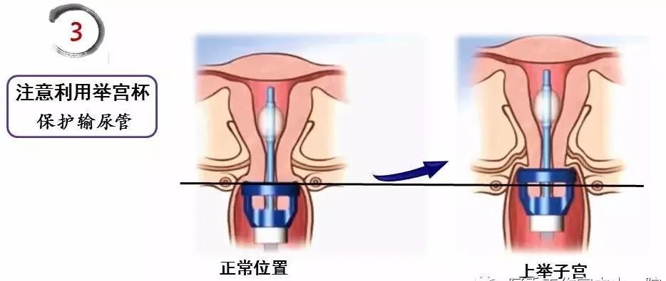 【腹腔镜篇】全子宫切除术手术技巧 【腹腔镜篇】全子宫切除术手术技巧