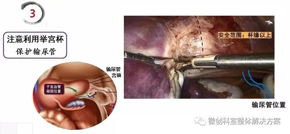 【腹腔镜篇】全子宫切除术手术技巧 【腹腔镜篇】全子宫切除术手术技巧