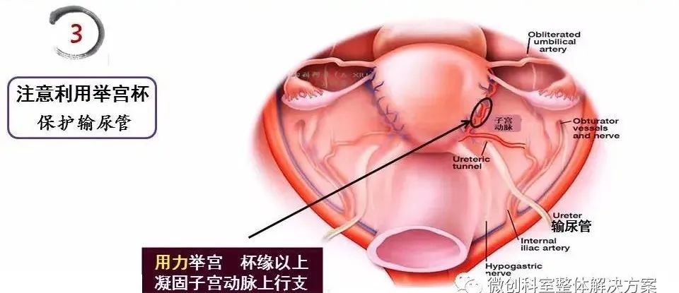 【腹腔镜篇】全子宫切除术手术技巧 【腹腔镜篇】全子宫切除术手术技巧