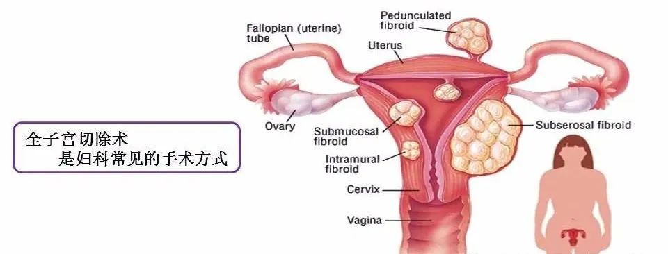 【腹腔镜篇】全子宫切除术手术技巧 【腹腔镜篇】全子宫切除术手术技巧