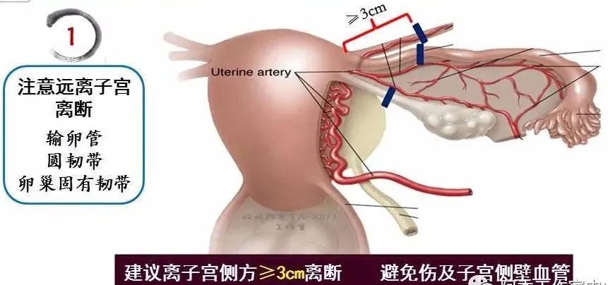 【腹腔镜篇】全子宫切除术手术技巧 【腹腔镜篇】全子宫切除术手术技巧