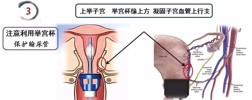 【腹腔镜篇】全子宫切除术手术技巧 【腹腔镜篇】全子宫切除术手术技巧