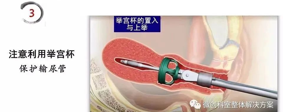 【腹腔镜篇】全子宫切除术手术技巧