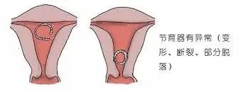 【宫腔镜篇】宫腔镜下宫内异物取出术 【宫腔镜篇】宫腔镜下宫内异物取出术