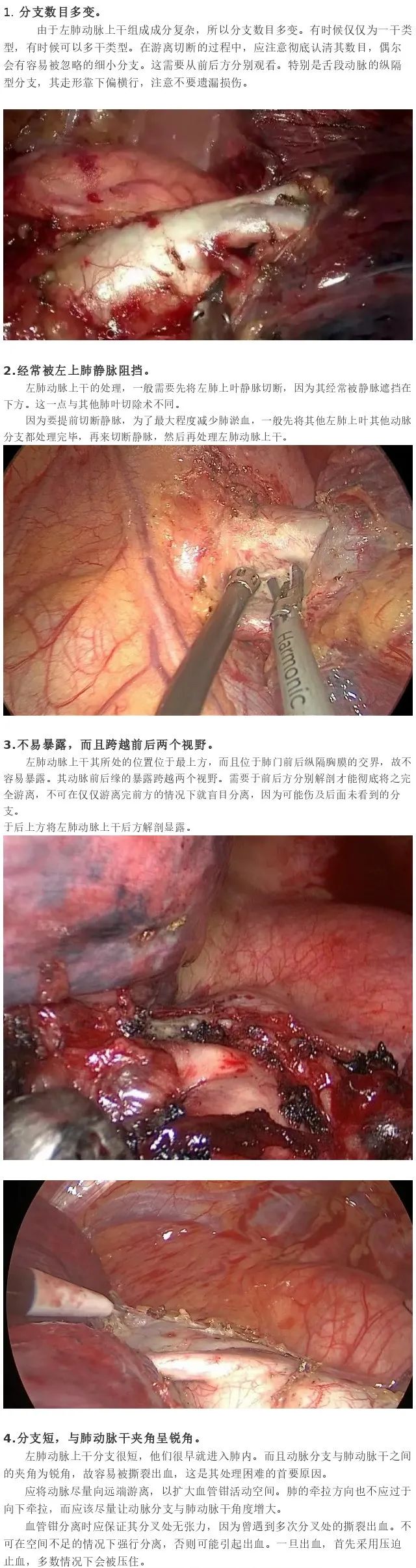 【胸腔镜篇】左肺动脉第一支的处理技巧 【胸腔镜篇】左肺动脉第一支的处理技巧