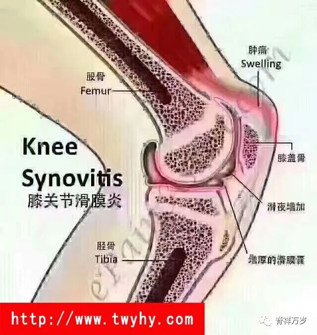 滑膜炎能自愈吗