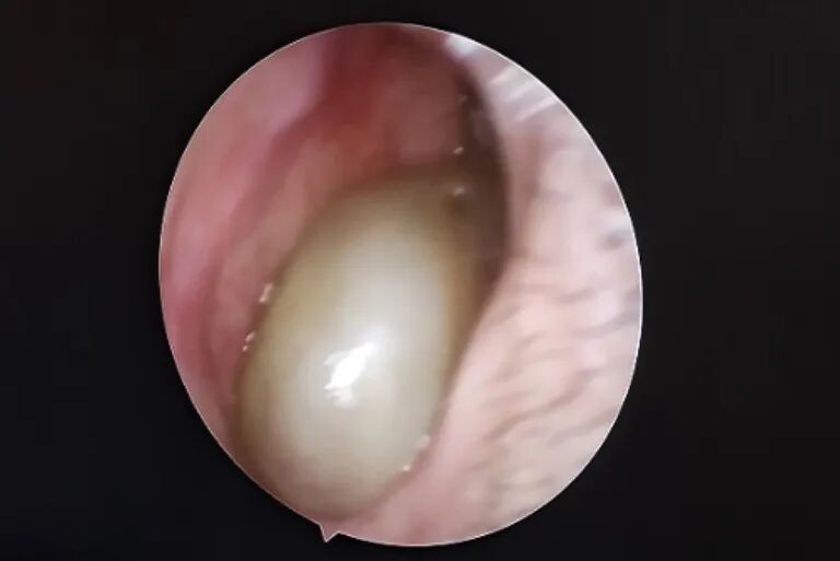 等离子刀头怎么使用刀头“止”血丨铁医耳鼻咽喉头颈外科应用等离子刀辅助鼻内镜手术走出特色路_https://www.jmylbn.com_新闻资讯_第9张