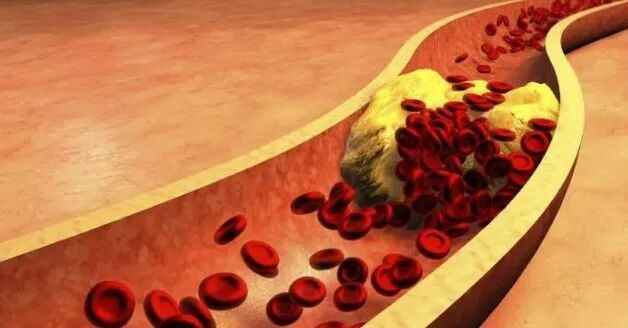 医用臭氧有什么作用“医用三氧大自血免疫疗法”具有氧化胆固醇的功能！_https://www.jmylbn.com_新闻资讯_第4张