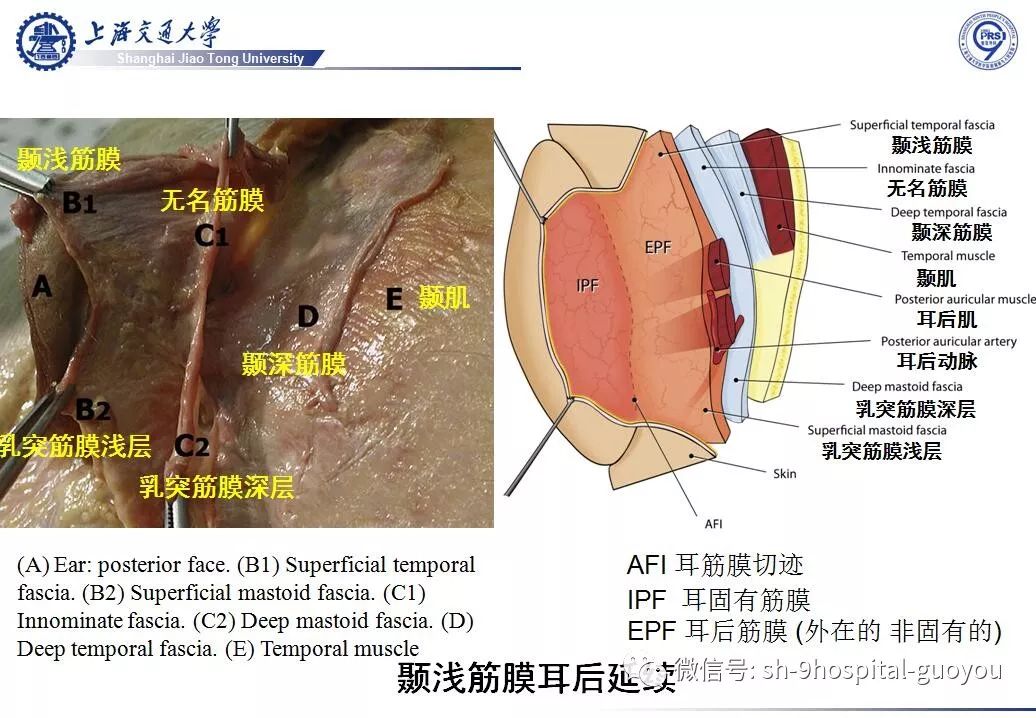 经典皮瓣系列之二 颞 顶 筋膜瓣临床应用解剖 九院张国佑 微信公众号文章阅读 Wemp