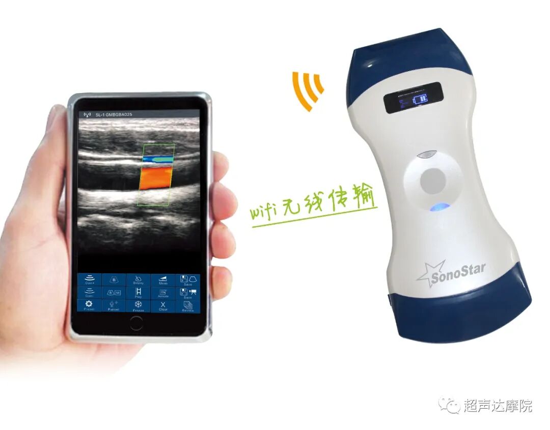 索诺星超声怎么样掌上超声新时代，来看看哪些是主流？_https://www.jmylbn.com_新闻资讯_第7张
