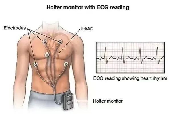 动态心电图仪器怎么看科学就医行动——动态心电图_https://www.jmylbn.com_新闻资讯_第11张