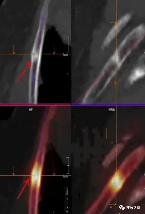 spectct局部骨断层融合显像的诊断价值知多少