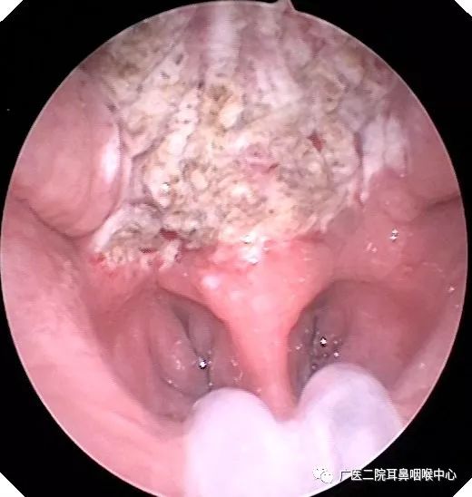 低温等离子在扁桃体腺样体手术中的应用