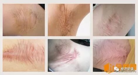 难道狐臭手术才是狐臭的最佳治疗方法吗？