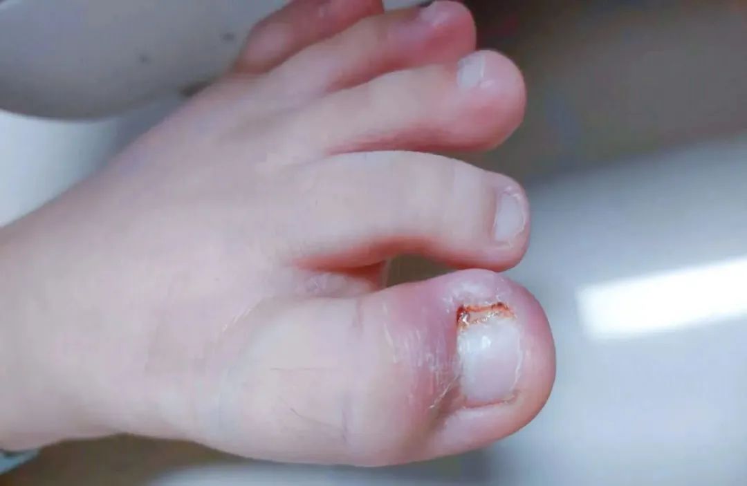 双脚大拇指肿胀儿童诊断照片医学科普经过诊断,小男孩确诊为甲沟炎