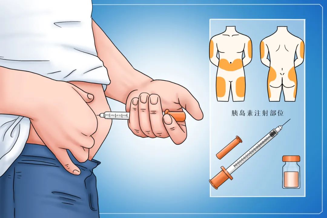 提升胰岛素注射效果的14条军规拿走不谢