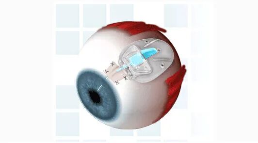 怎么装青光眼眼睛装“阀门” ，难治性青光眼不“难治”！_https://www.jmylbn.com_新闻资讯_第13张