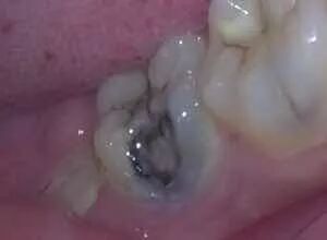 牙齿“早衰”的6个信号，出现一个就要警惕！