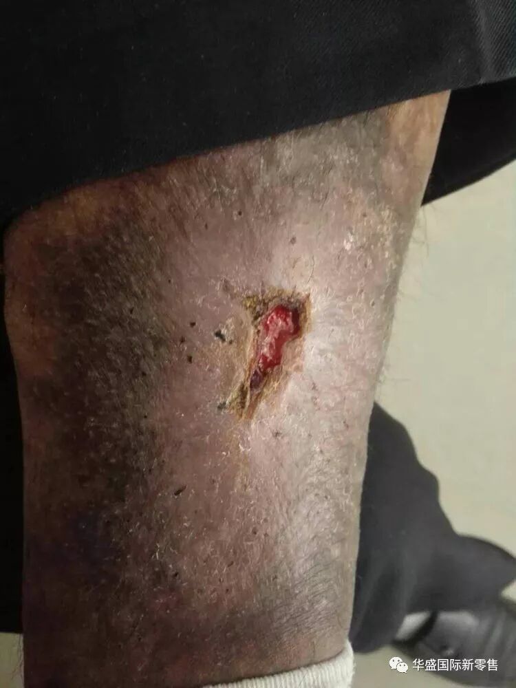 激光治疗仪能治什么病激光治疗仪案例整理【外伤，疼痛，皮肤疾病】_https://www.jmylbn.com_新闻资讯_第27张