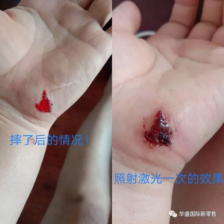 激光治疗仪能治什么病激光治疗仪案例整理【外伤，疼痛，皮肤疾病】_https://www.jmylbn.com_新闻资讯_第4张