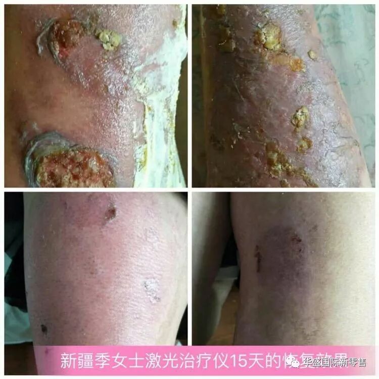 激光治疗仪能治什么病激光治疗仪案例整理【外伤，疼痛，皮肤疾病】_https://www.jmylbn.com_新闻资讯_第3张