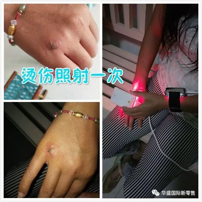 激光治疗仪能治什么病激光治疗仪案例整理【外伤，疼痛，皮肤疾病】_https://www.jmylbn.com_新闻资讯_第34张
