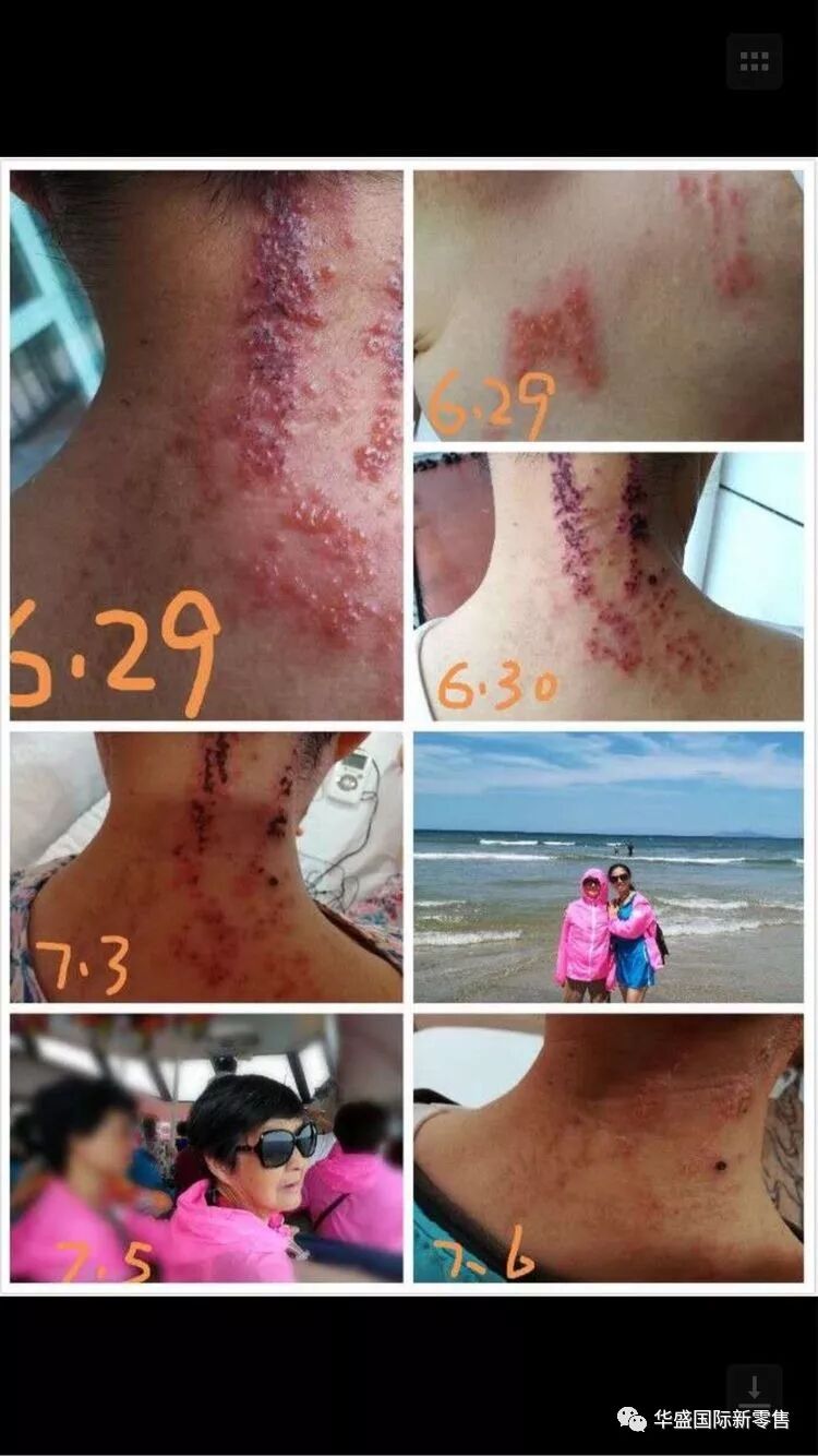 激光治疗仪能治什么病激光治疗仪案例整理【外伤，疼痛，皮肤疾病】_https://www.jmylbn.com_新闻资讯_第33张