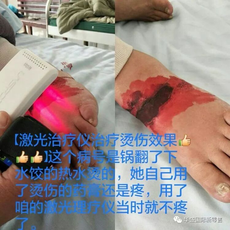 激光治疗仪能治什么病激光治疗仪案例整理【外伤，疼痛，皮肤疾病】_https://www.jmylbn.com_新闻资讯_第38张