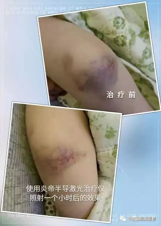 激光治疗仪能治什么病激光治疗仪案例整理【外伤，疼痛，皮肤疾病】_https://www.jmylbn.com_新闻资讯_第19张