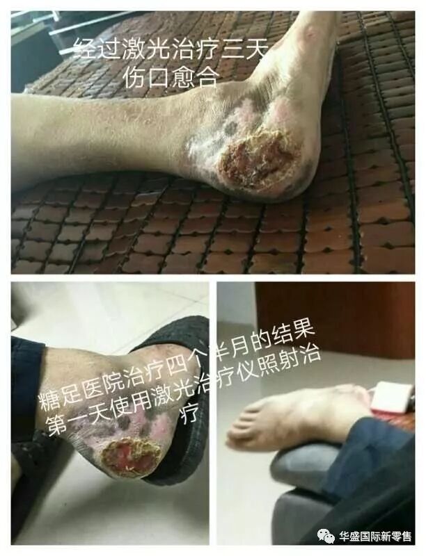 激光治疗仪能治什么病激光治疗仪案例整理【外伤，疼痛，皮肤疾病】_https://www.jmylbn.com_新闻资讯_第15张