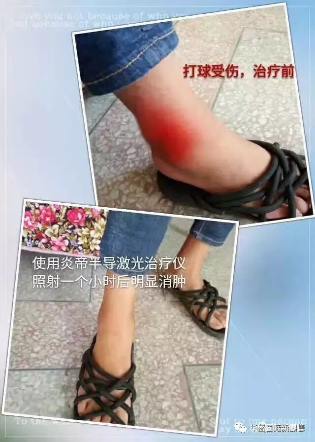 激光治疗仪能治什么病激光治疗仪案例整理【外伤，疼痛，皮肤疾病】_https://www.jmylbn.com_新闻资讯_第20张