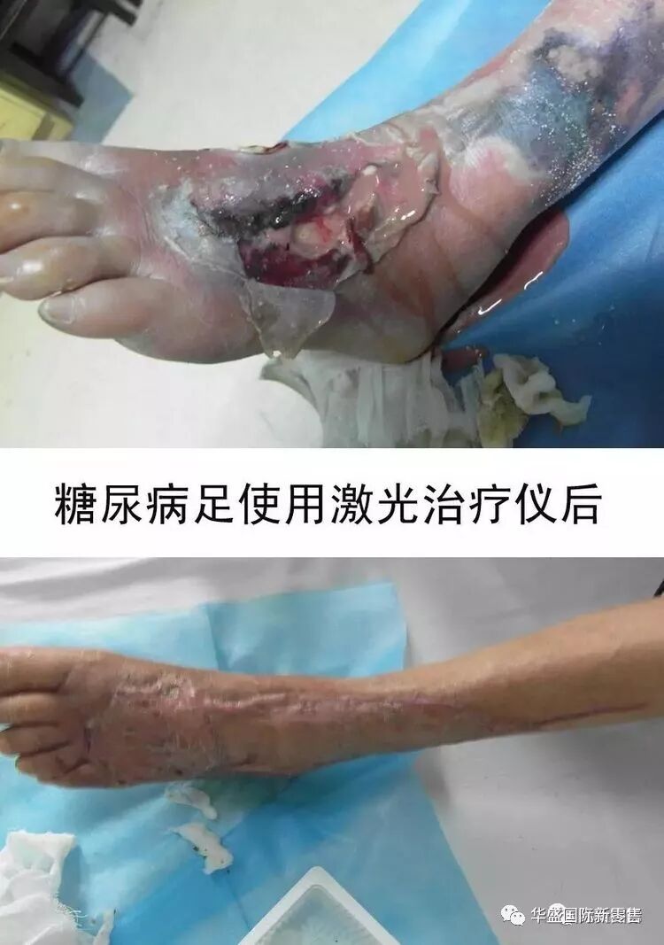 激光治疗仪能治什么病激光治疗仪案例整理【外伤，疼痛，皮肤疾病】_https://www.jmylbn.com_新闻资讯_第23张