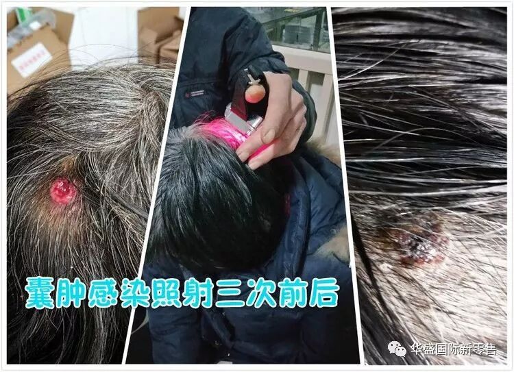 激光治疗仪能治什么病激光治疗仪案例整理【外伤，疼痛，皮肤疾病】_https://www.jmylbn.com_新闻资讯_第35张