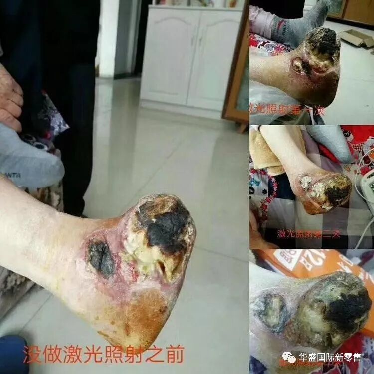 激光治疗仪能治什么病激光治疗仪案例整理【外伤，疼痛，皮肤疾病】_https://www.jmylbn.com_新闻资讯_第14张