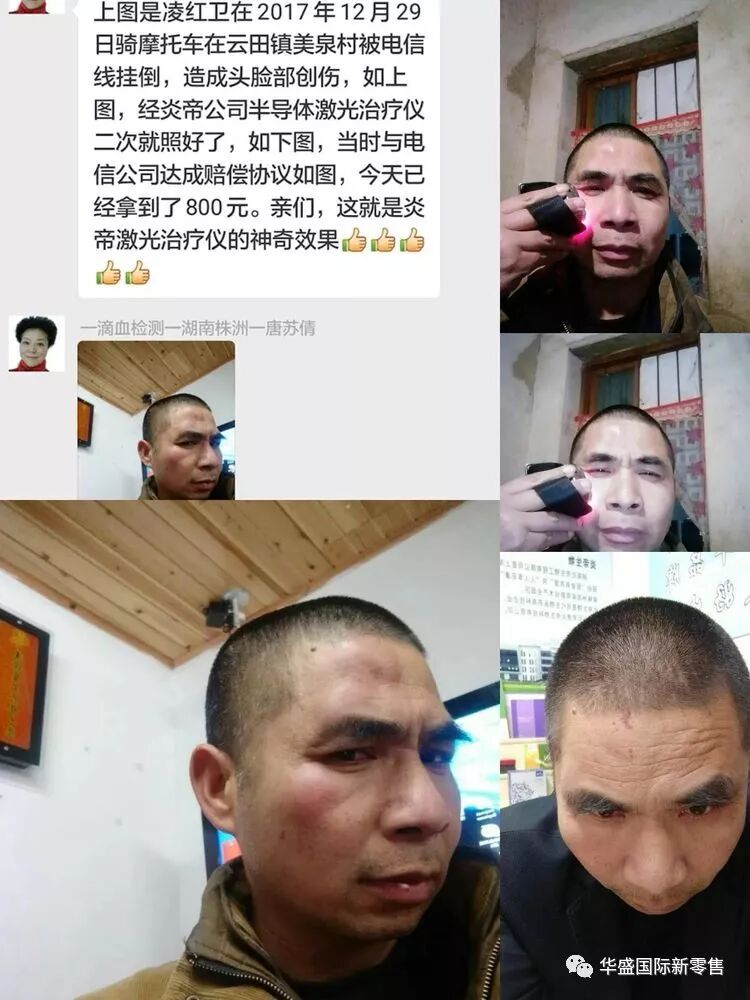 激光治疗仪能治什么病激光治疗仪案例整理【外伤，疼痛，皮肤疾病】_https://www.jmylbn.com_新闻资讯_第46张