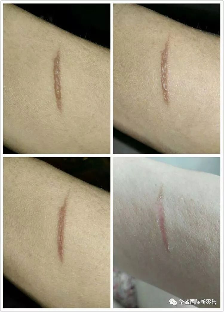 激光治疗仪能治什么病激光治疗仪案例整理【外伤，疼痛，皮肤疾病】_https://www.jmylbn.com_新闻资讯_第6张