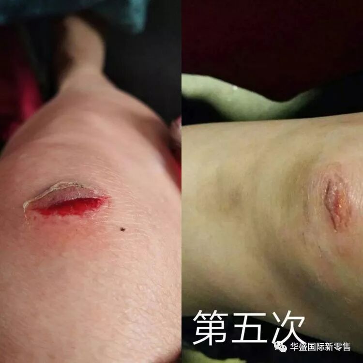 激光治疗仪能治什么病激光治疗仪案例整理【外伤，疼痛，皮肤疾病】_https://www.jmylbn.com_新闻资讯_第11张