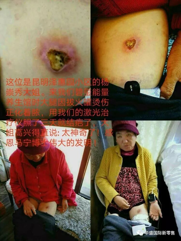 激光治疗仪能治什么病激光治疗仪案例整理【外伤，疼痛，皮肤疾病】_https://www.jmylbn.com_新闻资讯_第40张