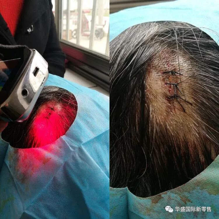 激光治疗仪能治什么病激光治疗仪案例整理【外伤，疼痛，皮肤疾病】_https://www.jmylbn.com_新闻资讯_第29张