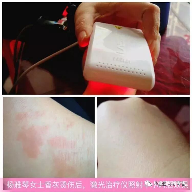 激光治疗仪能治什么病激光治疗仪案例整理【外伤，疼痛，皮肤疾病】_https://www.jmylbn.com_新闻资讯_第48张