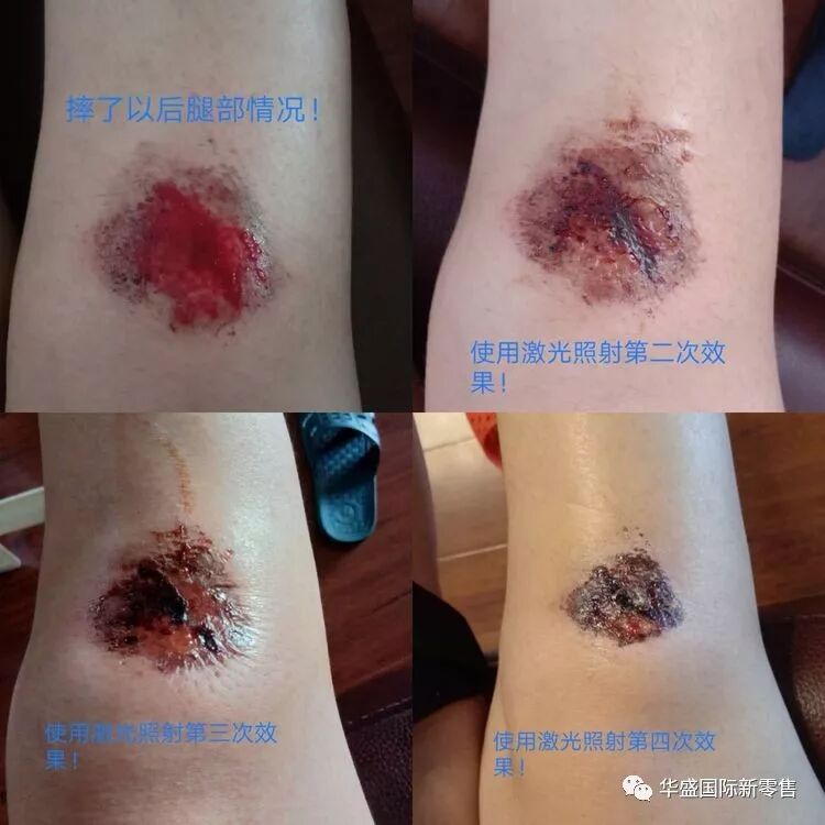 激光治疗仪能治什么病激光治疗仪案例整理【外伤，疼痛，皮肤疾病】_https://www.jmylbn.com_新闻资讯_第5张