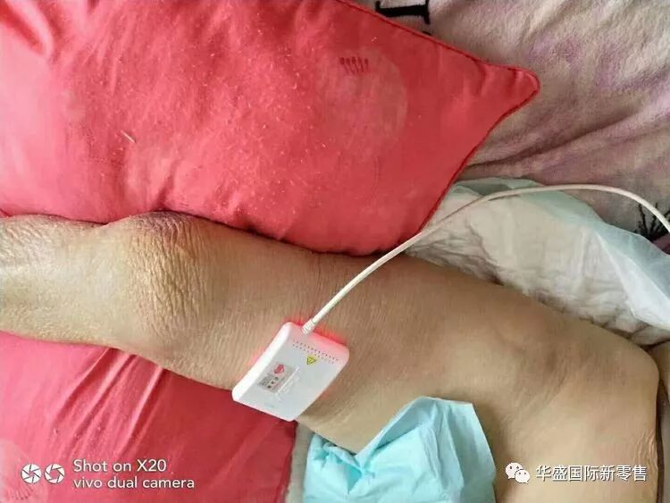 激光治疗仪能治什么病激光治疗仪案例整理【外伤，疼痛，皮肤疾病】_https://www.jmylbn.com_新闻资讯_第28张